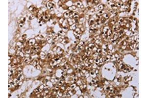 The image is immunohistochemistry of paraffin-embedded human prostate cancer tissue using ABIN7190062(CASP8AP2 Antibody) at dilution 1/20. (FLASH antibody)