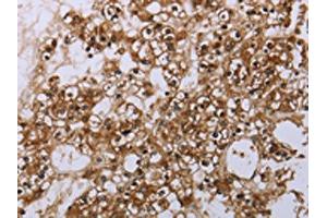 The image is immunohistochemistry of paraffin-embedded human prostate cancer tissue using ABIN7190062(CASP8AP2 Antibody) at dilution 1/20.