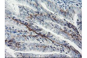 Immunohistochemical staining of paraffin-embedded Adenocarcinoma of Human endometrium tissue using anti-DTNB mouse monoclonal antibody. (Dystrobrevin beta antibody)