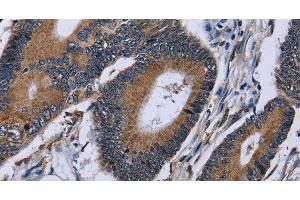 Immunohistochemistry of paraffin-embedded Human colon cancer using IPO4 Polyclonal Antibody at dilution of 1:50 (Importin 4 antibody)