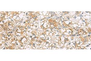Immunohistochemistry of paraffin-embedded Human liver cancer tissue using TLE6 Polyclonal Antibody at dilution of 1:75(x200) (TLE6 antibody)