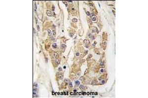 Formalin-fixed and paraffin-embedded human breast carcinoma tissue reacted with COT Antibody (C-term) (ABIN392472 and ABIN2842056) , which was peroxidase-conjugated to the secondary antibody, followed by DAB staining. (MAP3K8 antibody  (C-Term))