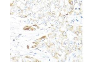 Immunohistochemistry of paraffin-embedded Human liver cancer using HSD17B10 Polyclonal Antibody at dilution of 1:100 (40x lens). (HSD17B10 antibody)