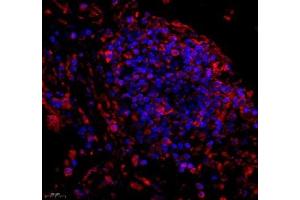 Immunofluorescence of paraffin embedded human lung cancer using C1orf173 (ABIN7074073) at dilution of 1: 150 (450x lens) (Glutamate-Rich Protein 3 (ERICH3) antibody)