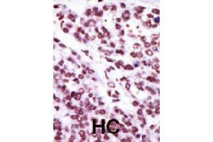 Formalin-fixed and paraffin-embedded human hepatocellular carcinoma tissue reacted with PRKCE polyclonal antibody  , which was peroxidase-conjugated to the secondary antibody, followed by AEC staining . (PKC epsilon antibody  (AA 213-243))