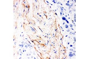 Anti- Decorin Picoband antibody, IHC(P) IHC(P): Human Mammary Cancer Tissue (Decorin antibody  (AA 31-359))
