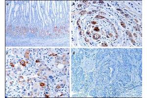 Immunohistochemical analysis of EphB1 in gastric cancer tissues.