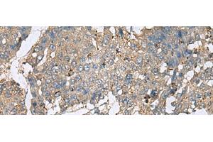 Immunohistochemistry of paraffin-embedded Human liver cancer tissue using PLA2G2A Polyclonal Antibody at dilution of 1:50(x200) (PLA2G2A antibody)