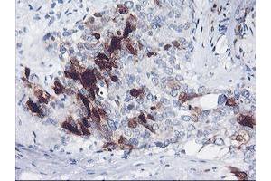 Immunohistochemical staining of paraffin-embedded Adenocarcinoma of Human breast tissue using anti-SERPINB2 mouse monoclonal antibody. (SERPINB2 antibody)