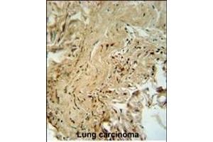PK14 Antibody (/) f immunohistochemistry analysis in forlin fixed and paraffin embedded hun lung carcino followed by peroxidase conjugation of the secondary antibody and DAB staining. (MAPK14 antibody  (AA 158-192))