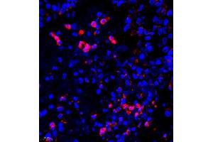 Immunofluorescence of paraffin embedded human lung cancer using UBE3A (ABIN7076105) at dilution of 1:650 (400x lens) (ube3a antibody)