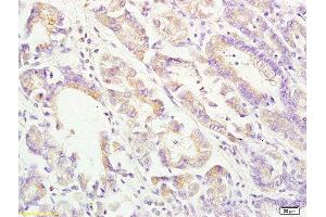 Formalin-fixed and paraffin embedded human gastric carcinoma labeled with Rabbit Anti ApoA4 Polyclonal Antibody, Unconjugated  at 1:200 followed by conjugation to the secondary antibody and DAB staining