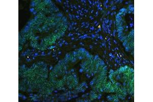 IF analysis of TPR using anti-TPR antibody (ABIN5693275) TPR was detected in paraffin-embedded section of human intestinal cancer tissues. (TPR antibody)