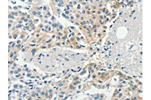 The image on the left is immunohistochemistry of paraffin-embedded Human breast cancer tissue using ABIN7190467(DGKB Antibody) at dilution 1/60, on the right is treated with synthetic peptide. (DGKB antibody)