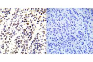 Immunohistochemical analysis of paraffin-embedded human malignant lymphoma tissue using Histone H3. (Histone H3.1 antibody  (pSer28))