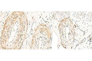 Immunohistochemistry of paraffin-embedded Human cervical cancer tissue using GPR160 Polyclonal Antibody at dilution of 1:35(x200) (GPR160 antibody)