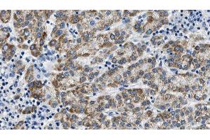 ABIN6275017 at 1/100 staining Human liver cancer tissue by IHC-P.