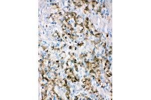 Anti-ALDH3A1 antibody, IHC(P) IHC(P): Human Gastric Cancer Tissue (ALDH3A1 antibody  (C-Term))