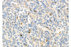 ABIN6262689 and ABIN6277155 at 1/100 staining Human kidney cancer by IHC-P. (Integrin beta 2 antibody  (N-Term))