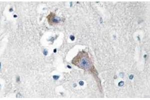 Immunohistochemistry (IHC) analyzes of CaMKIIalpha/delta antibody in paraffin-embedded human breast carcinoma tissue.
