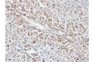 IHC-P Image Immunohistochemical analysis of paraffin-embedded human glioma, using HSP70 1B, antibody at 1:100 dilution. (HSPA1B antibody  (Center))