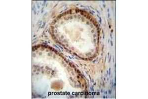 NUDT8 antibody (N-term) (ABIN654517 and ABIN2844241) immunohistochemistry analysis in formalin fixed and paraffin embedded human prostate carcinoma followed by peroxidase conjugation of the secondary antibody and DAB staining.