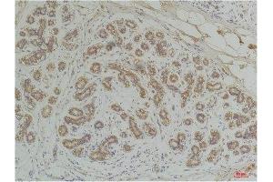 Immunohistochemistry (IHC) analysis of paraffin-embedded Human Breast Carcinoma using EphA1 Rabbit Polyclonal Antibody diluted at 1:200.