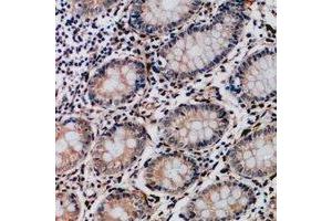 Immunohistochemical analysis of Collagen 17 alpha 1 staining in human colon cancer formalin fixed paraffin embedded tissue section.