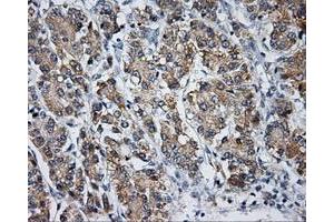 Immunohistochemical staining of paraffin-embedded Carcinoma of liver tissue using anti-LIPG mouse monoclonal antibody. (LIPG antibody)