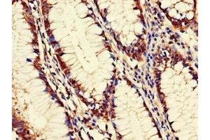 Immunohistochemistry of paraffin-embedded human colon cancer using ABIN7162603 at dilution of 1:100 (PANK2 antibody  (AA 437-490))