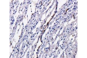 Immunohistochemical staining of human ovarian cancer using anti-TAG72 antibody  Formalin fixed human ovarian cancer slices were were stained with  at 5 µg/ml. (Recombinant TAG-72 (Satumomab Biosimilar) antibody)