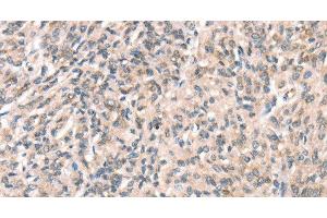 Immunohistochemistry of paraffin-embedded Human prostate cancer using DECR1 Polyclonal Antibody at dilution of 1:50 (DECR1 antibody)