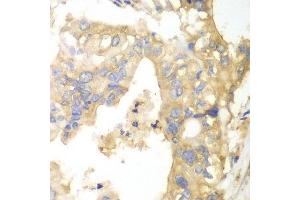 Immunohistochemistry of paraffin-embedded human liver cancer using PYGB antibody. (PYGB antibody  (AA 544-843))