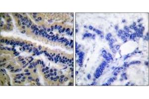 Immunohistochemistry analysis of paraffin-embedded human lung carcinoma tissue, using Caspase 9 (Cleaved-Asp353) Antibody.