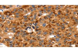 Immunohistochemistry of paraffin-embedded Human liver cancer using TLN1 Polyclonal Antibody at dilution of 1:35 (TLN1 antibody)