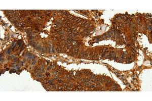 Immunohistochemistry of paraffin-embedded Human colon cancer tissue using CEACAM21 Polyclonal Antibody at dilution 1:60 (CEACAM21 antibody)