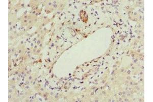 Immunohistochemistry of paraffin-embedded human liver cancer using ABIN7167073 at dilution of 1:100 (HBXIP antibody  (AA 1-91))