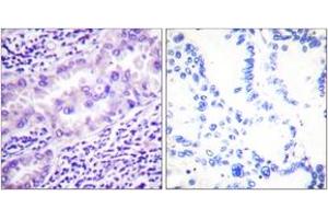 Immunohistochemistry analysis of paraffin-embedded human lung carcinoma, using PP2A-alpha (Phospho-Tyr307) Antibody. (PPP2CA antibody  (pTyr307))