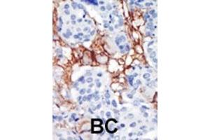 Formalin-fixed and paraffin-embedded human cancer tissue reacted with the primary antibody, which was peroxidase-conjugated to the secondary antibody, followed by AEC staining. (PIP4K2B antibody  (C-Term))