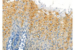 ABIN6262909 and ABIN6273260 at 1/100 staining Human esophageal cancer and adjacent normal tissues by IHC-P. (LAPTM4B antibody  (Internal Region))
