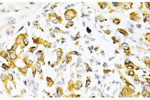 Immunohistochemistry of paraffin-embedded Human gastric cancer using TAPBP Polyclonal Antibody at dilution of 1:200 (40x lens).