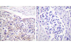 Immunohistochemistry analysis of paraffin-embedded human breast carcinoma tissue using p90 RSK (Phospho-Thr573) antibody. (RPS6KA3 antibody  (pThr573))