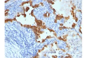Formalin-fixed, paraffin-embedded human Lung Carcinoma stained with Cytokeratin 8/18 Monoclonal Antibody (B22. (Cytokeratin 8/18 antibody)