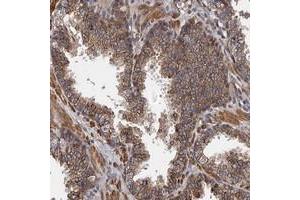 Immunohistochemical staining of human prostate with KIAA1609 polyclonal antibody  shows moderate cytoplasmic positivity in glandular cells at 1:500-1:1000 dilution. (KIAA1609 antibody)