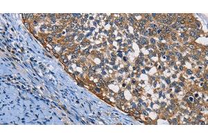 Immunohistochemistry of paraffin-embedded Human cervical cancer using PGK1 Polyclonal Antibody at dilution of 1:50 (PGK1 antibody)