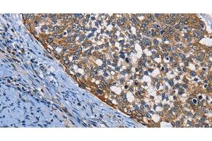 Immunohistochemistry of paraffin-embedded Human cervical cancer using PGK1 Polyclonal Antibody at dilution of 1:50 (PGK1 antibody)