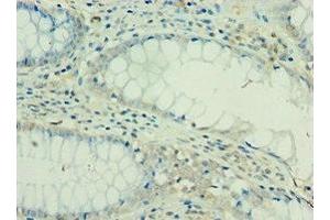 Immunohistochemistry of paraffin-embedded human colon cancer using ABIN7156908 at dilution of 1:100 (FIL1d antibody  (AA 1-155))