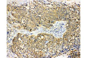 Anti-Haptoglobin antibody, IHC(P) IHC(P): Human Lung Cancer Tissue (Haptoglobin antibody  (Middle Region))