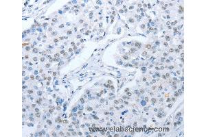 Immunohistochemistry of Human lung cancer using ARHGEF2 Polyclonal Antibody at dilution of 1:30