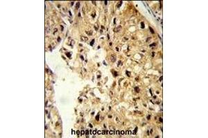 Formalin-fixed and paraffin-embedded human hepatocarcinoma reacted with PCBD1 Antibody (Center), which was peroxidase-conjugated to the secondary antibody, followed by DAB staining. (PCBD1 antibody  (AA 11-37))